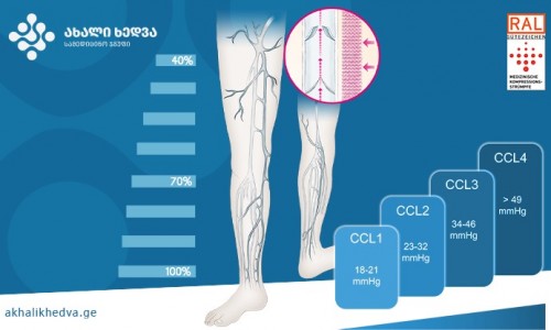 რა მოთხოვნებს უნდა აკმაყოფილებდეს სამედიცინო კომპრესიული წინდა?-ახალი ხედვა